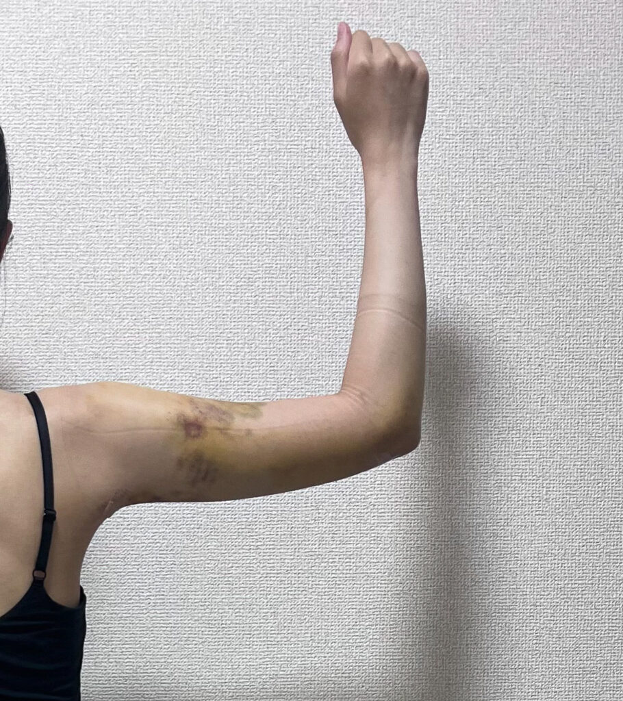 二の腕の脂肪吸引