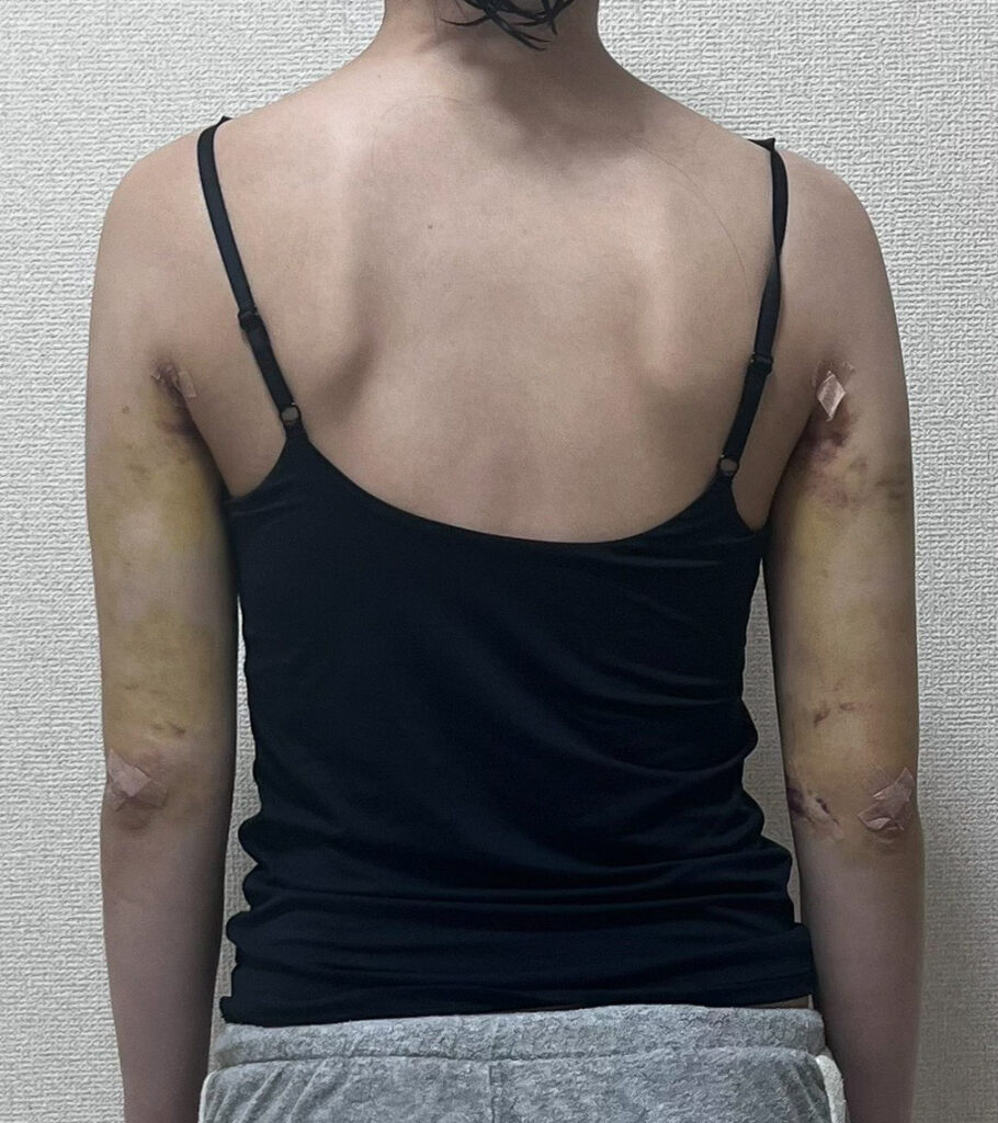 二の腕の脂肪吸引