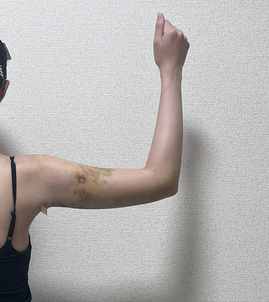 二の腕の脂肪吸引