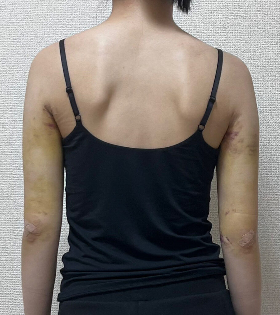 二の腕の脂肪吸引