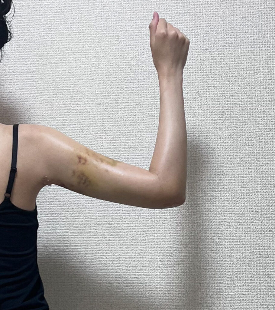 二の腕の脂肪吸引