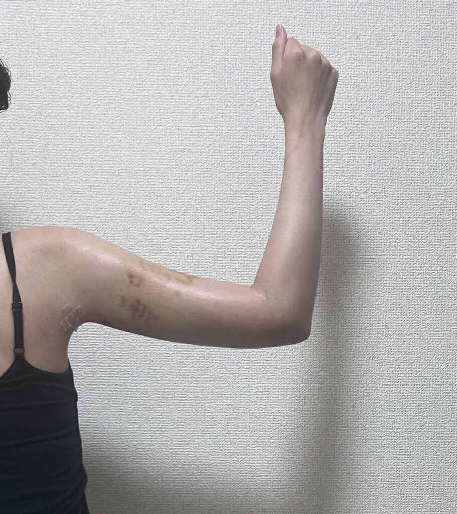 二の腕の脂肪吸引