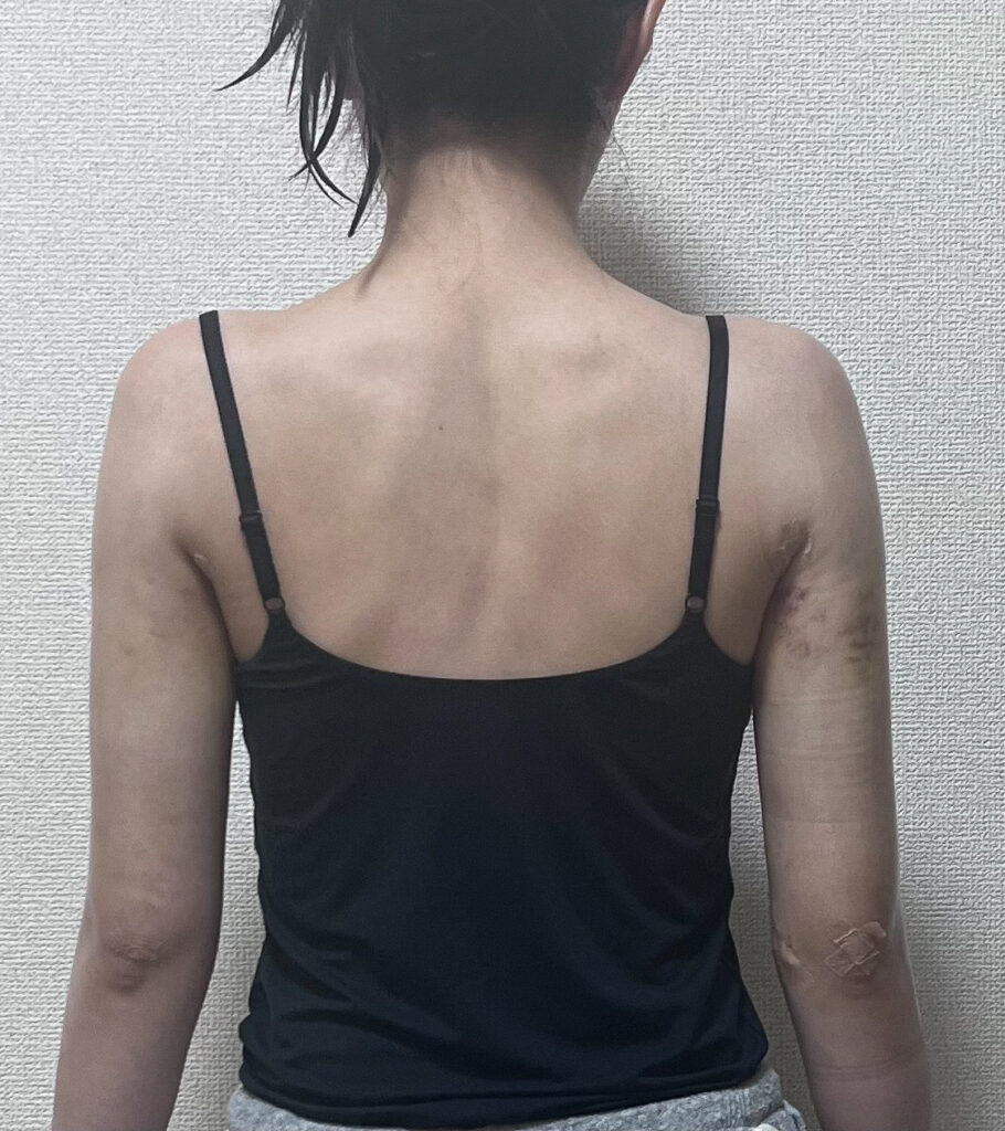 二の腕の脂肪吸引