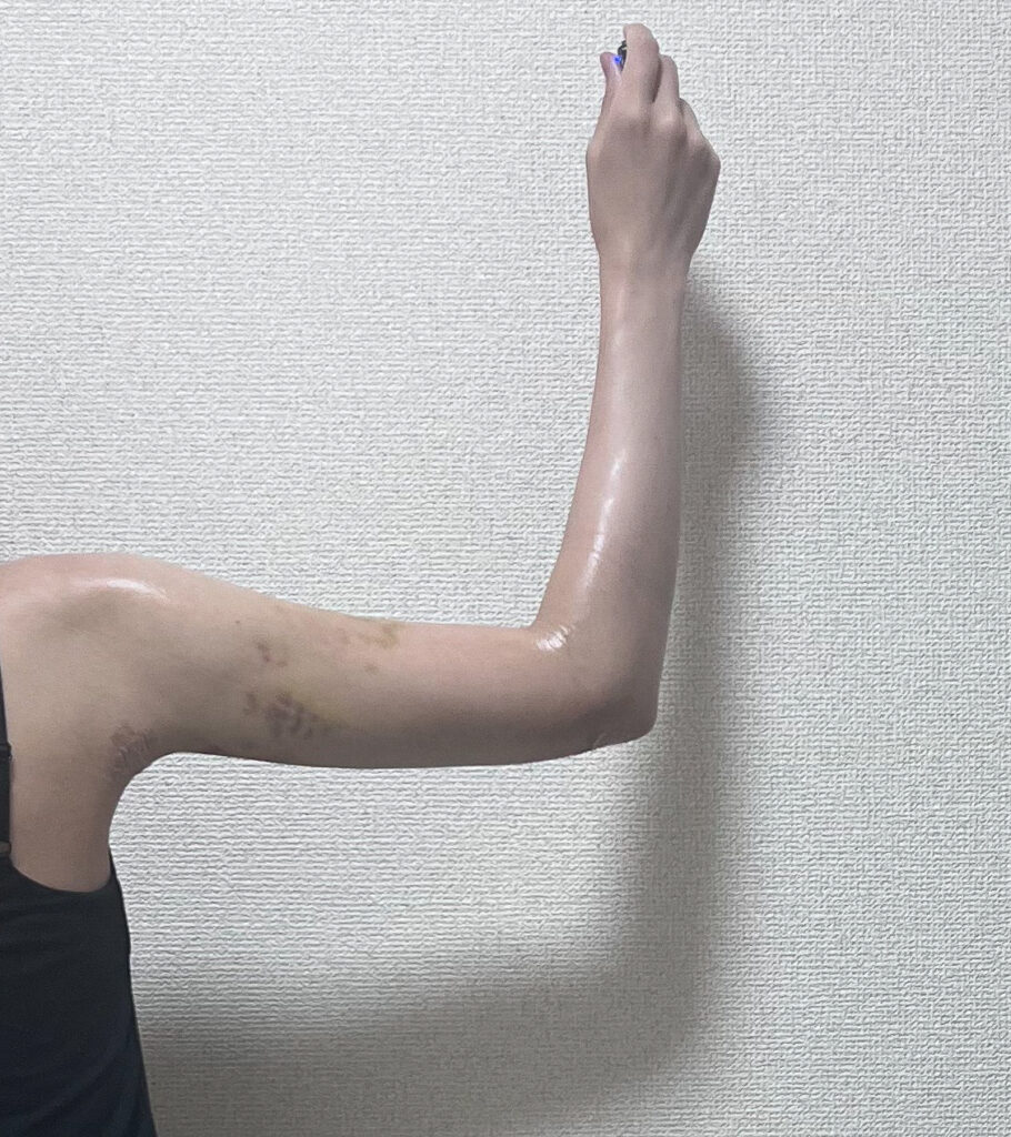 二の腕の脂肪吸引