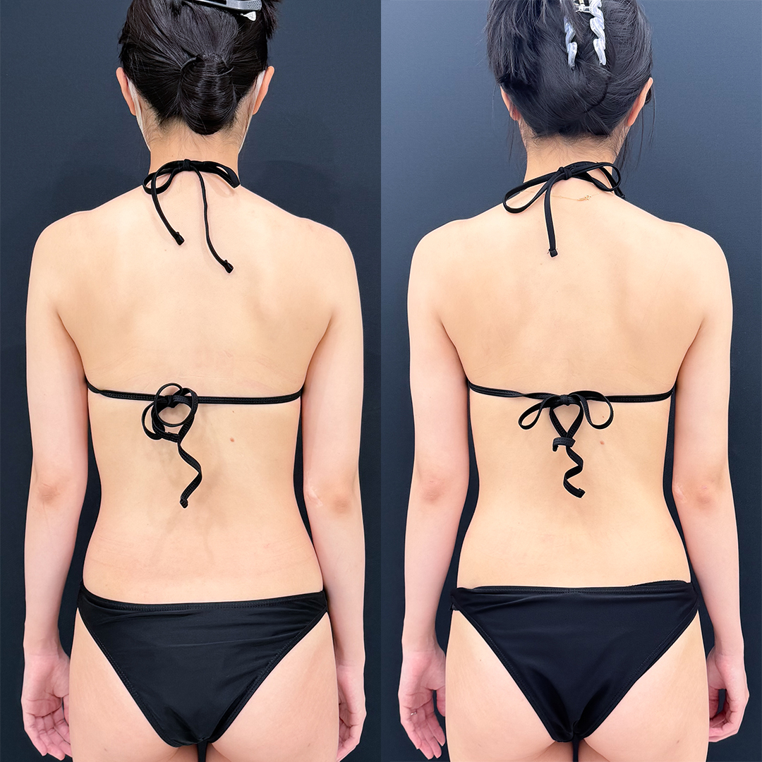 二の腕の脂肪吸引