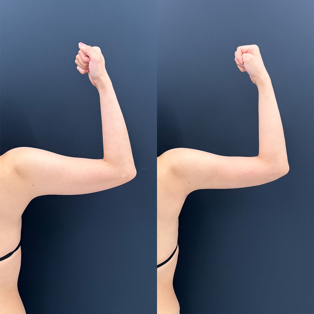 https://purelys-tokyo-clinic.com/wp/wp-content/uploads/2026/01/arm-Liposuction_Case-No.460.jpg