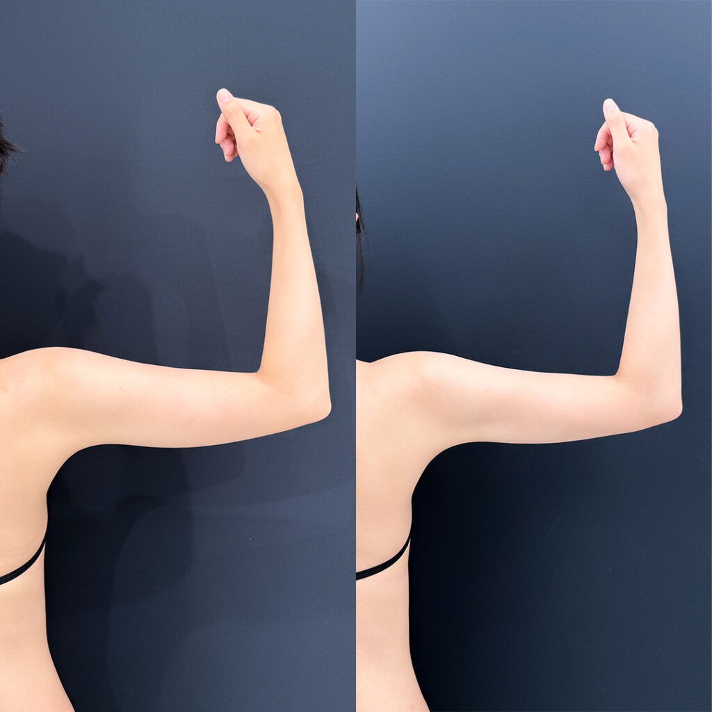 二の腕の脂肪吸引