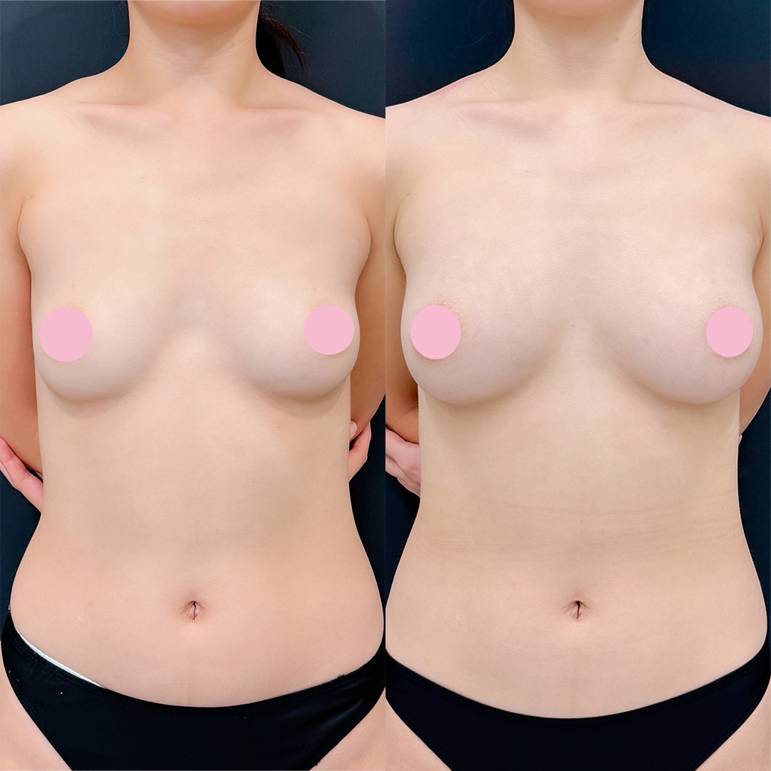 https://purelys-tokyo-clinic.com/wp/wp-content/uploads/2026/01/breast-augmentation_Case-No.37.jpg