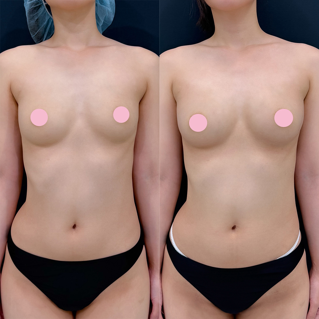 https://purelys-tokyo-clinic.com/wp/wp-content/uploads/2026/01/breast-augmentation_Case-No.38.jpg
