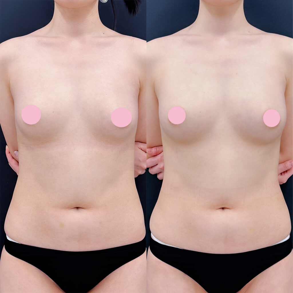 脂肪豊胸