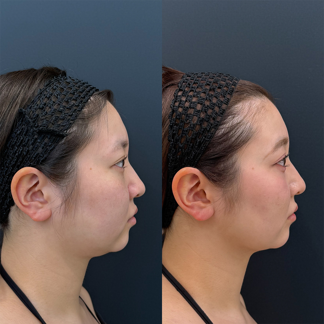 https://purelys-tokyo-clinic.com/wp/wp-content/uploads/2026/01/face-Liposuction_Case-No.280.jpg