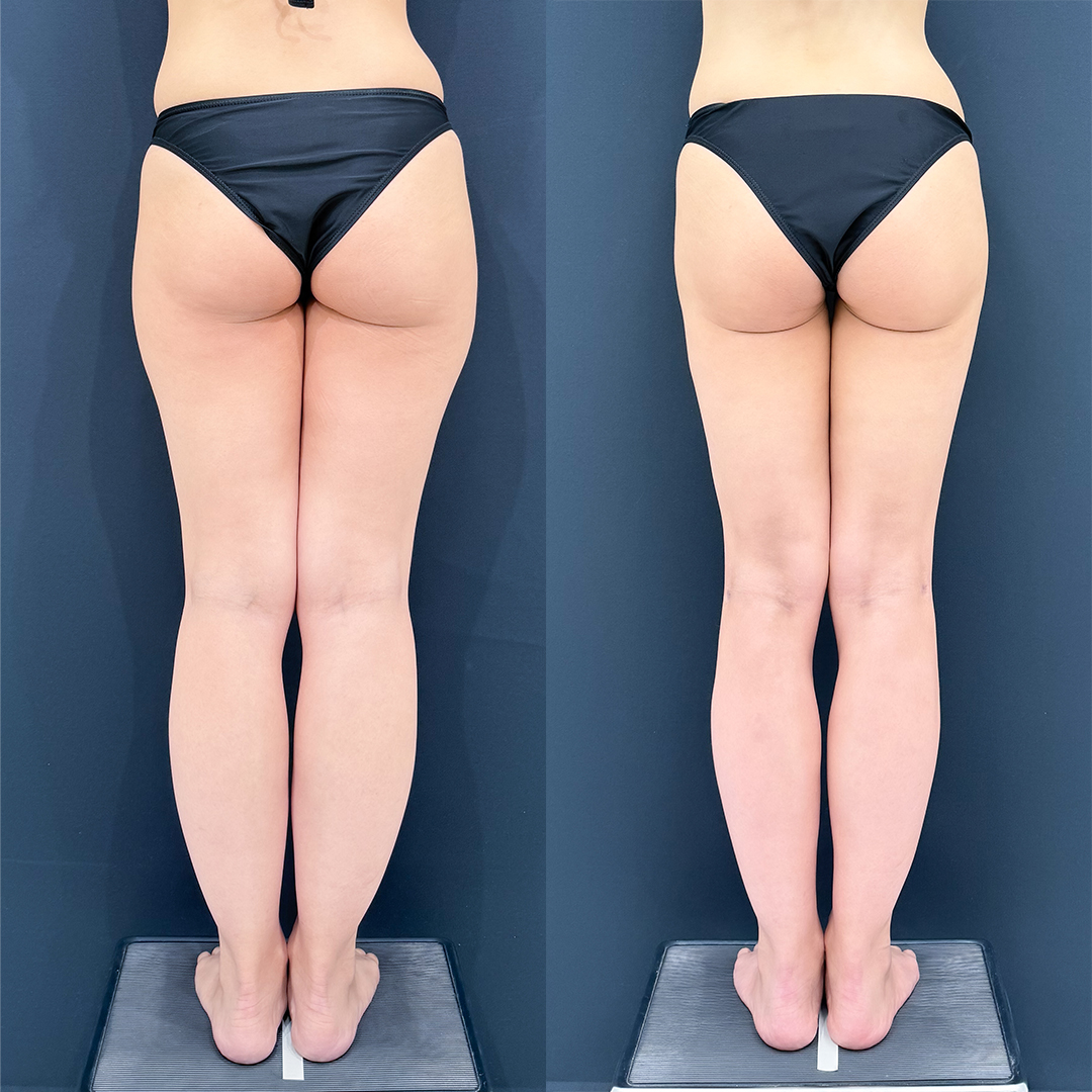 https://purelys-tokyo-clinic.com/wp/wp-content/uploads/2026/01/leg-Liposuction_Case-No.508.jpg