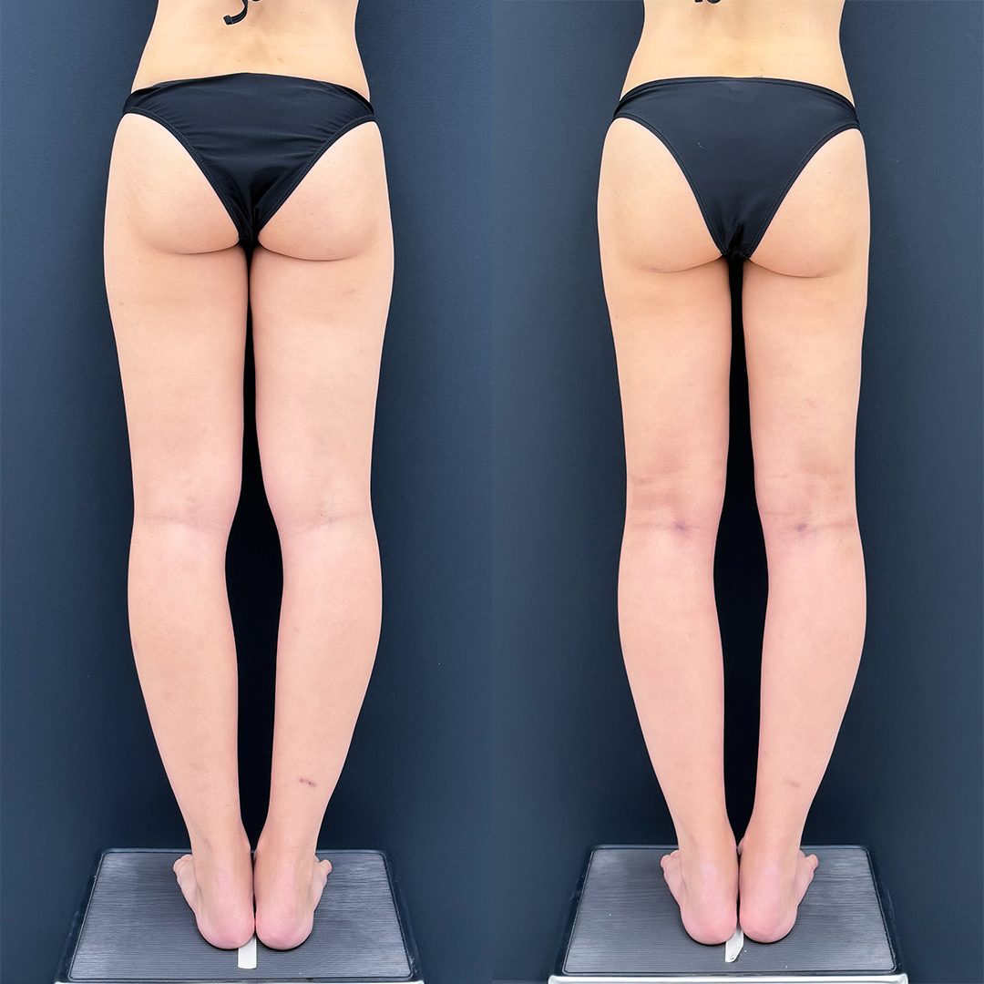 https://purelys-tokyo-clinic.com/wp/wp-content/uploads/2026/01/leg-Liposuction_Case-No.574.jpg