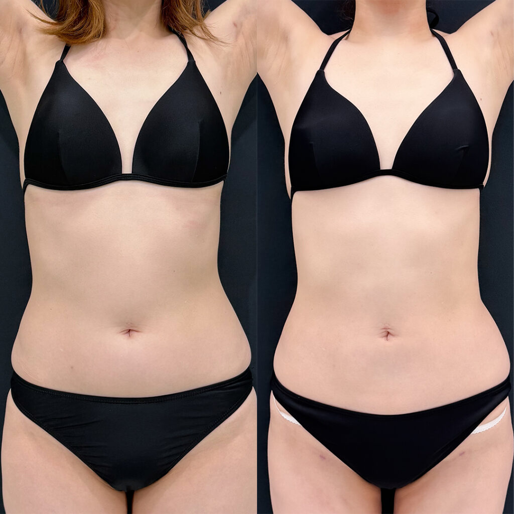 お腹の脂肪吸引