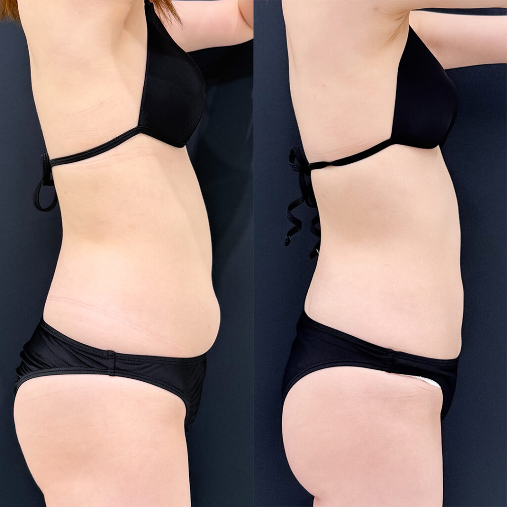 お腹の脂肪吸引