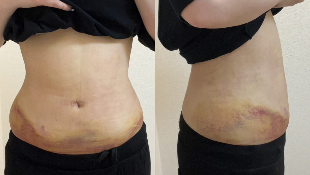 複数箇所に内出血がある腹部の正面と側面