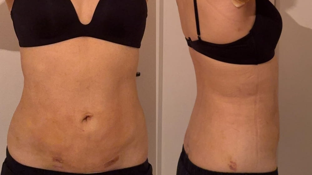 お腹脂肪吸引術後14日目