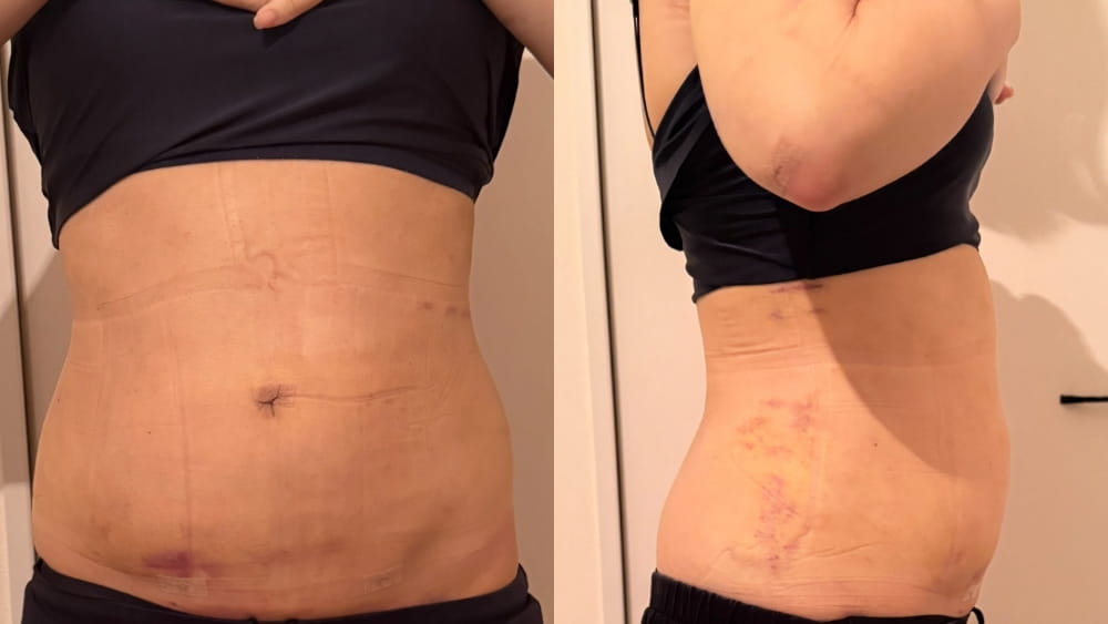 女性の腹部と脇腹のあざと跡