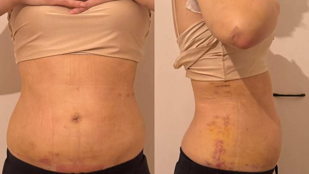 女性の腹部と脇腹のお腹脂肪吸引術後4日目