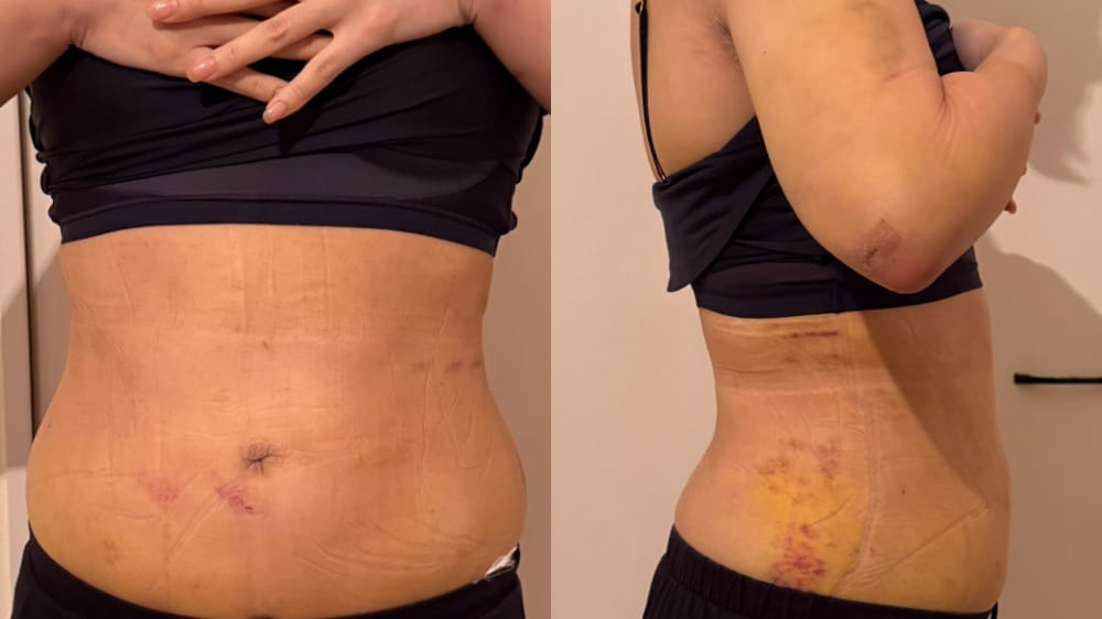 お腹脂肪吸引術後5日目