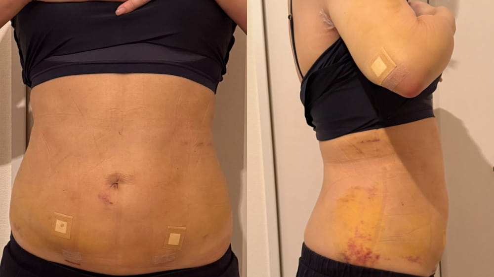 お腹脂肪吸引術後7日目