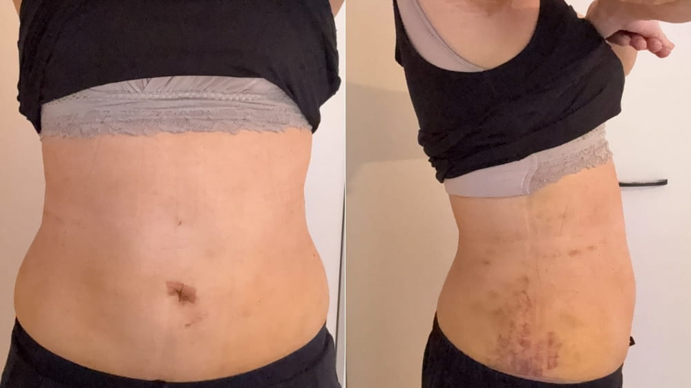 お腹脂肪吸引術後9日目