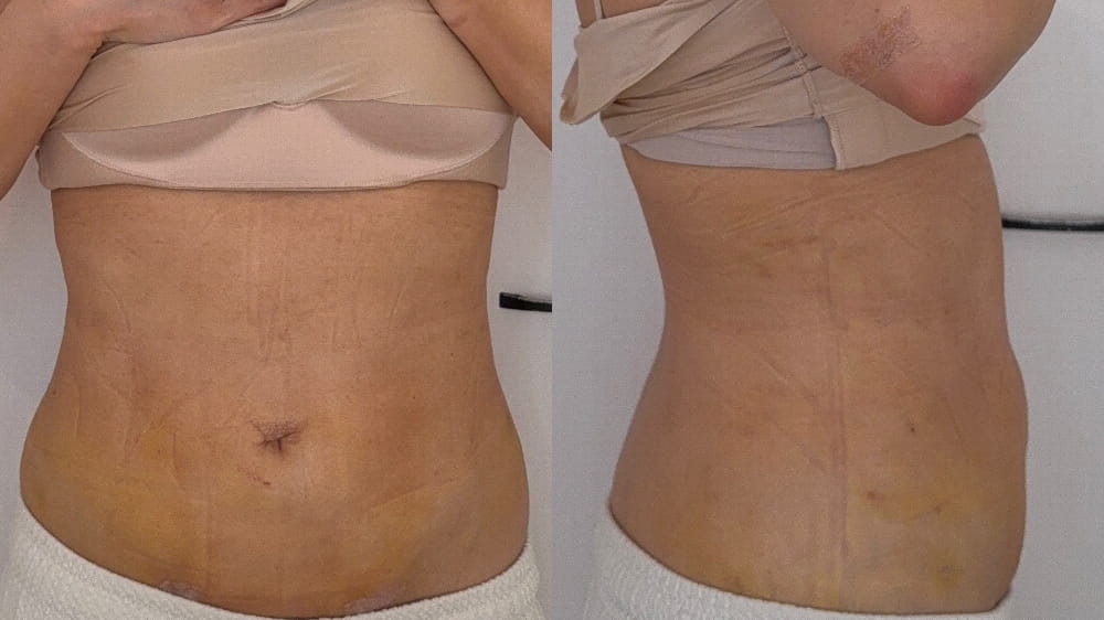 お腹脂肪吸引術後12日目