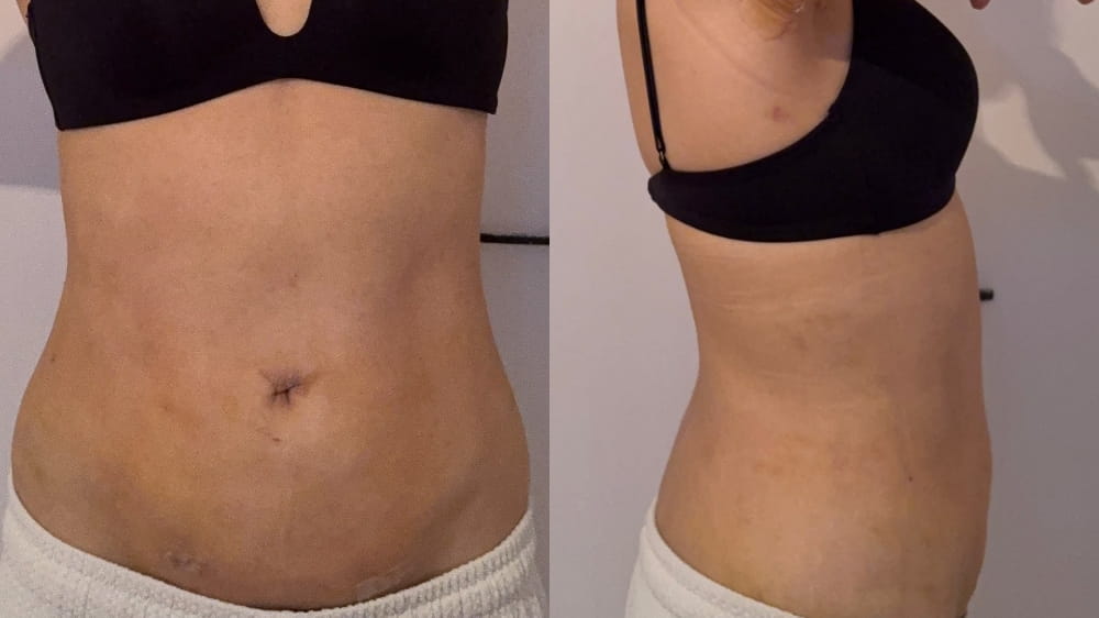 お腹脂肪吸引術後13日目