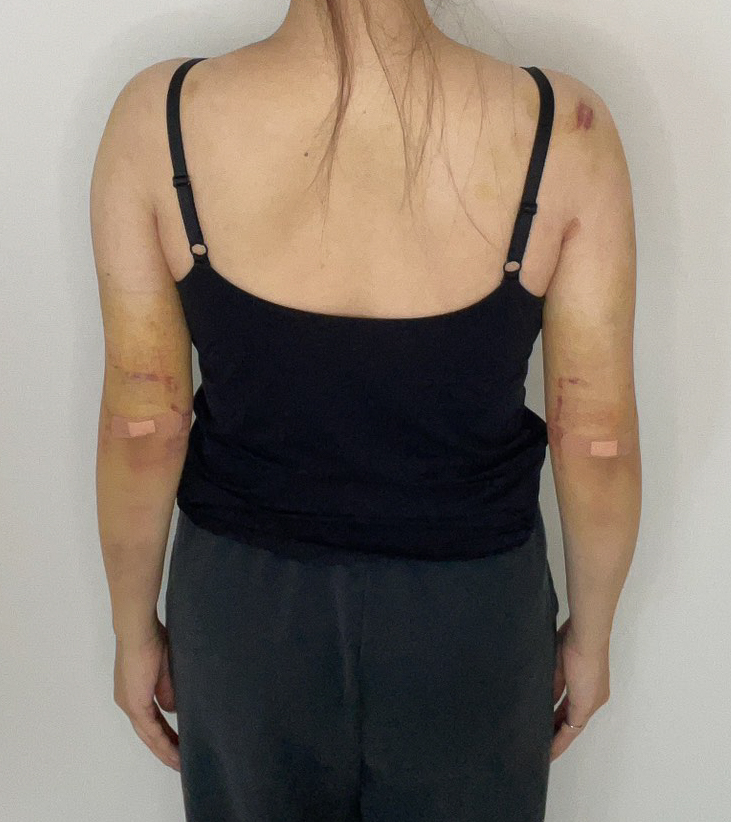 二の腕の脂肪吸引