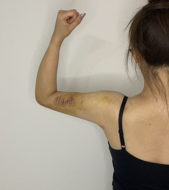 二の腕の脂肪吸引