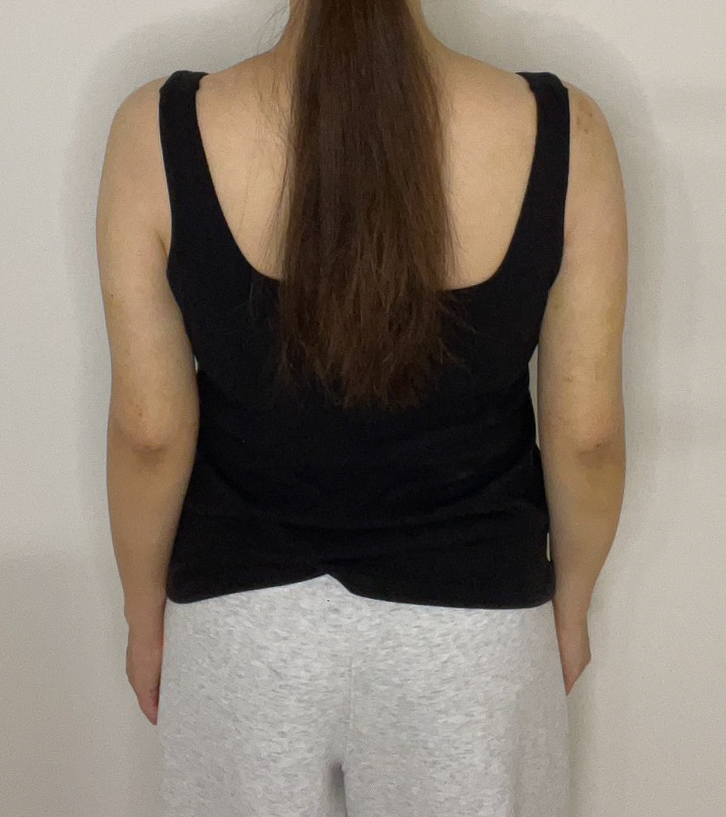 二の腕の脂肪吸引