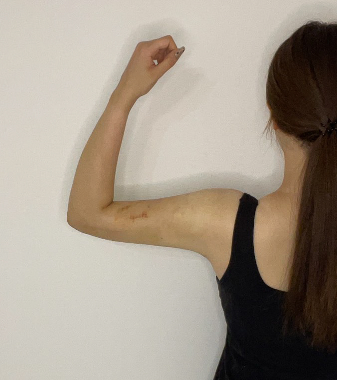 二の腕の脂肪吸引