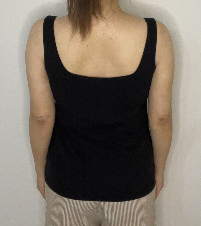 二の腕の脂肪吸引