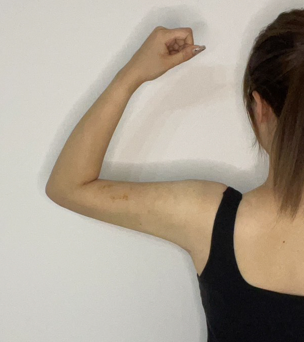 二の腕の脂肪吸引