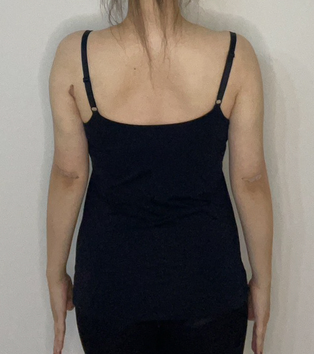 二の腕の脂肪吸引