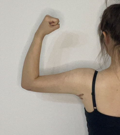 二の腕の脂肪吸引