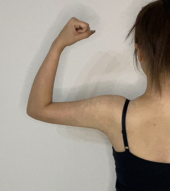 二の腕の脂肪吸引