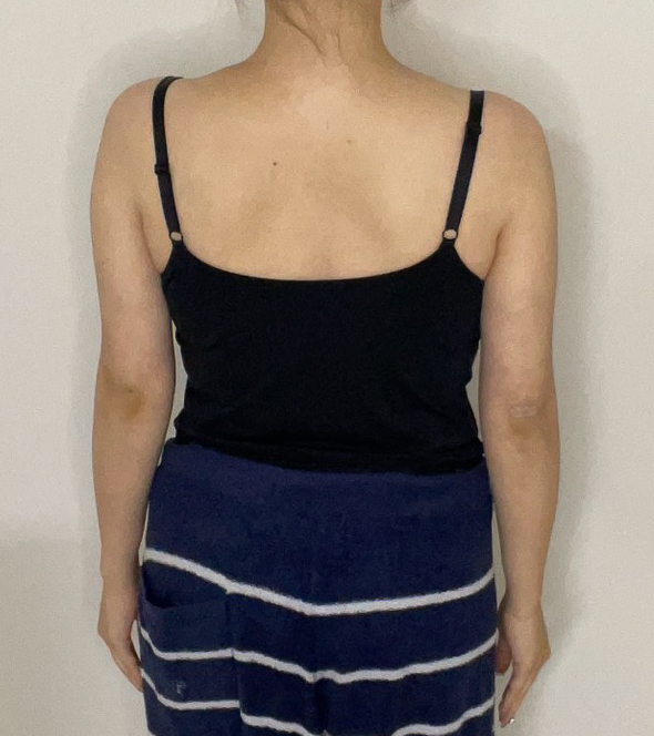 二の腕の脂肪吸引