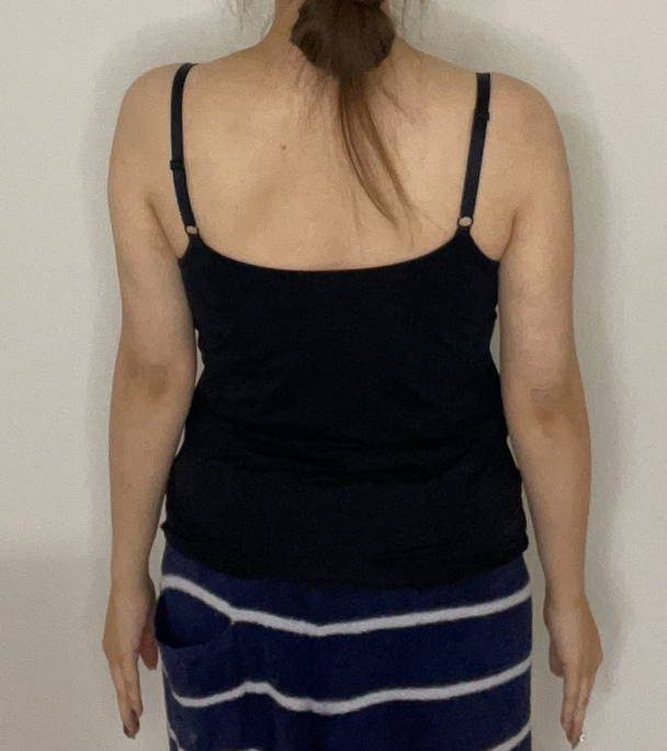 二の腕の脂肪吸引