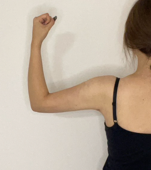 二の腕の脂肪吸引