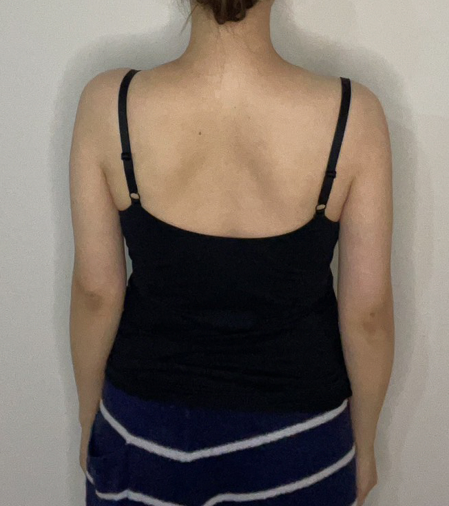 二の腕の脂肪吸引