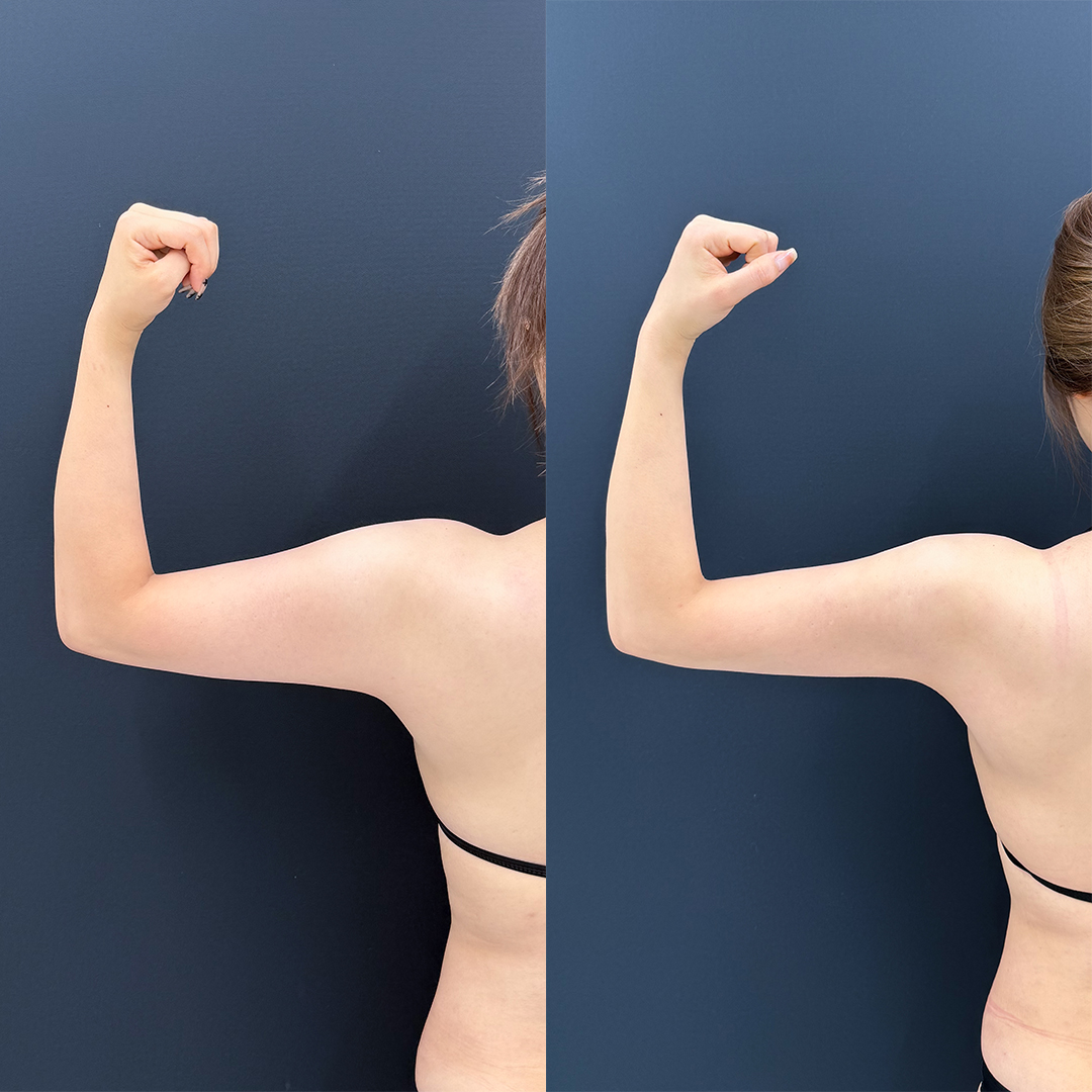 https://purelys-tokyo-clinic.com/wp/wp-content/uploads/2026/02/arm-Liposuction_Case-No.498.jpg