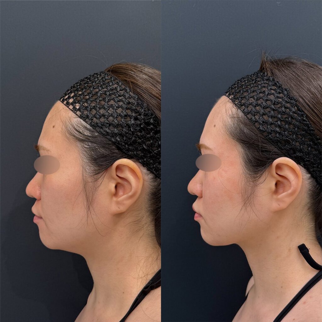 女性の施術前と施術後の比較 横顔