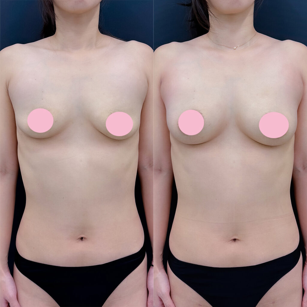 脂肪豊胸