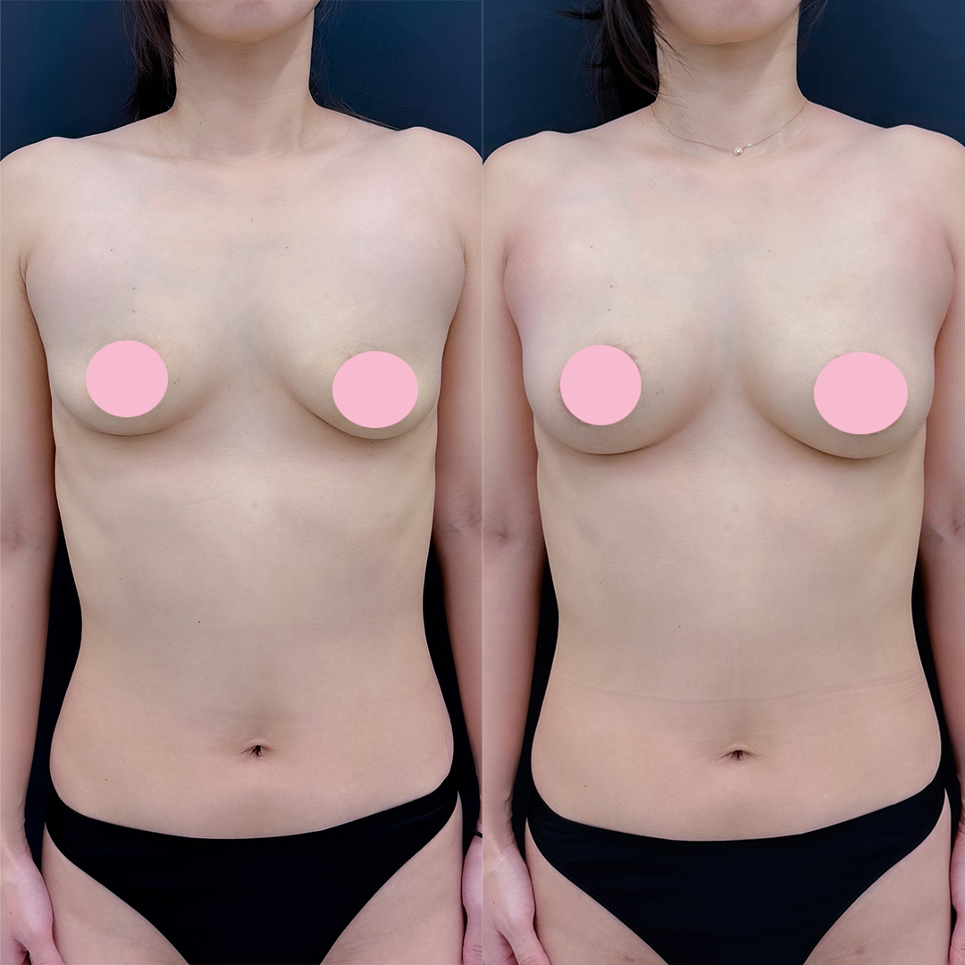 脂肪豊胸