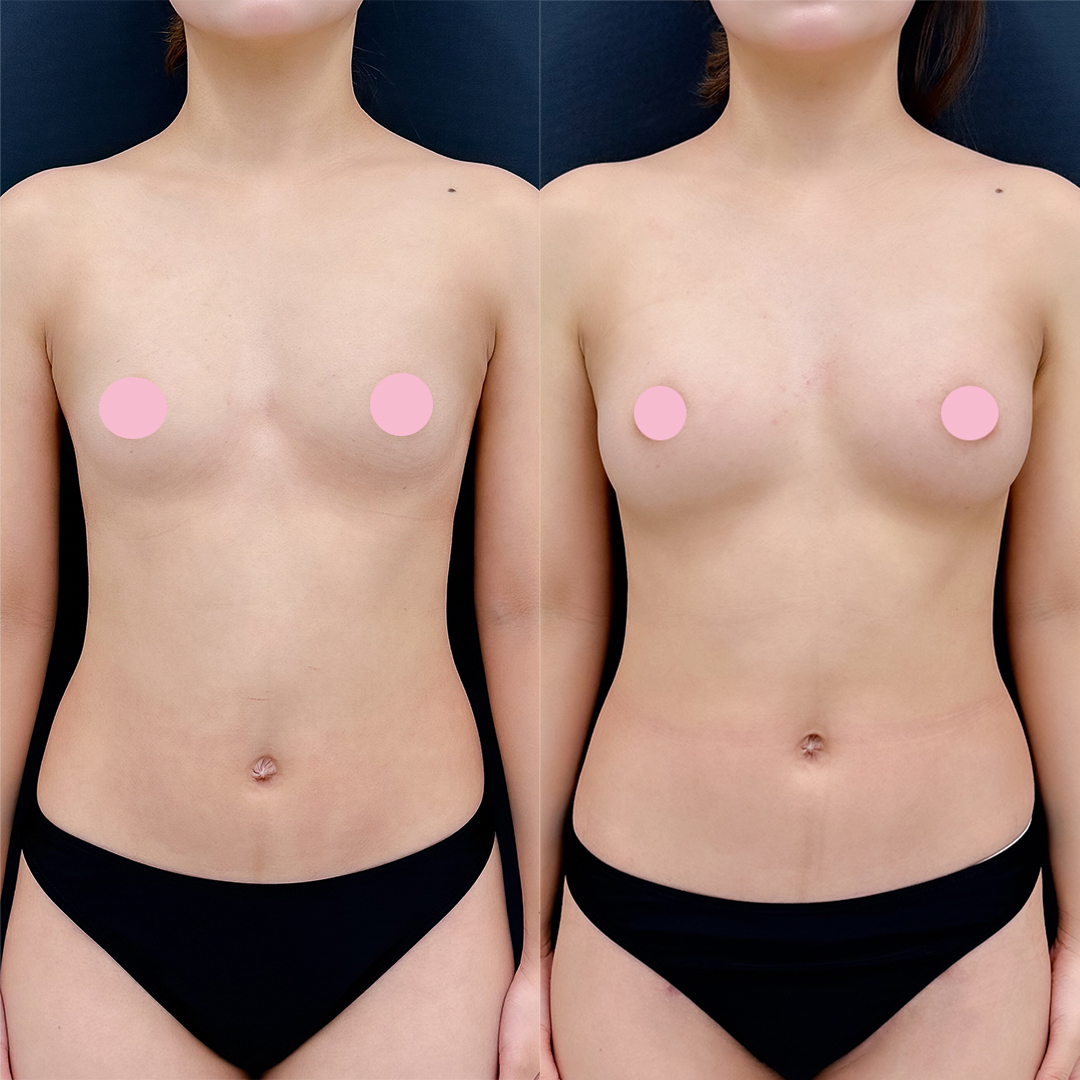 https://purelys-tokyo-clinic.com/wp/wp-content/uploads/2026/02/breast-augmentation_Case-No.98.jpg