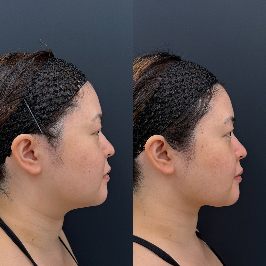 https://purelys-tokyo-clinic.com/wp/wp-content/uploads/2026/02/face-Liposuction_Case-No.320.jpg