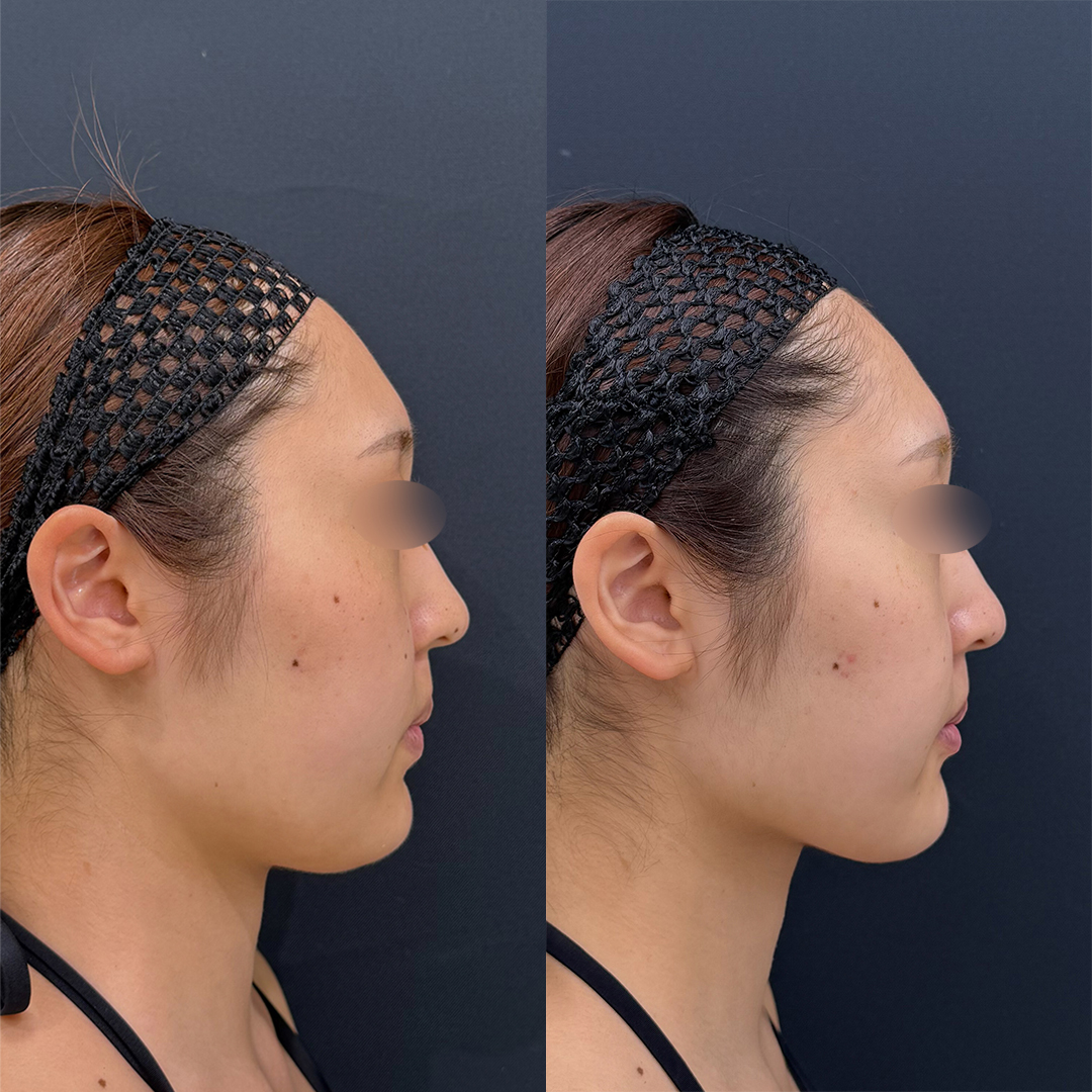https://purelys-tokyo-clinic.com/wp/wp-content/uploads/2026/02/face-Liposuction_Case-No.355.jpg
