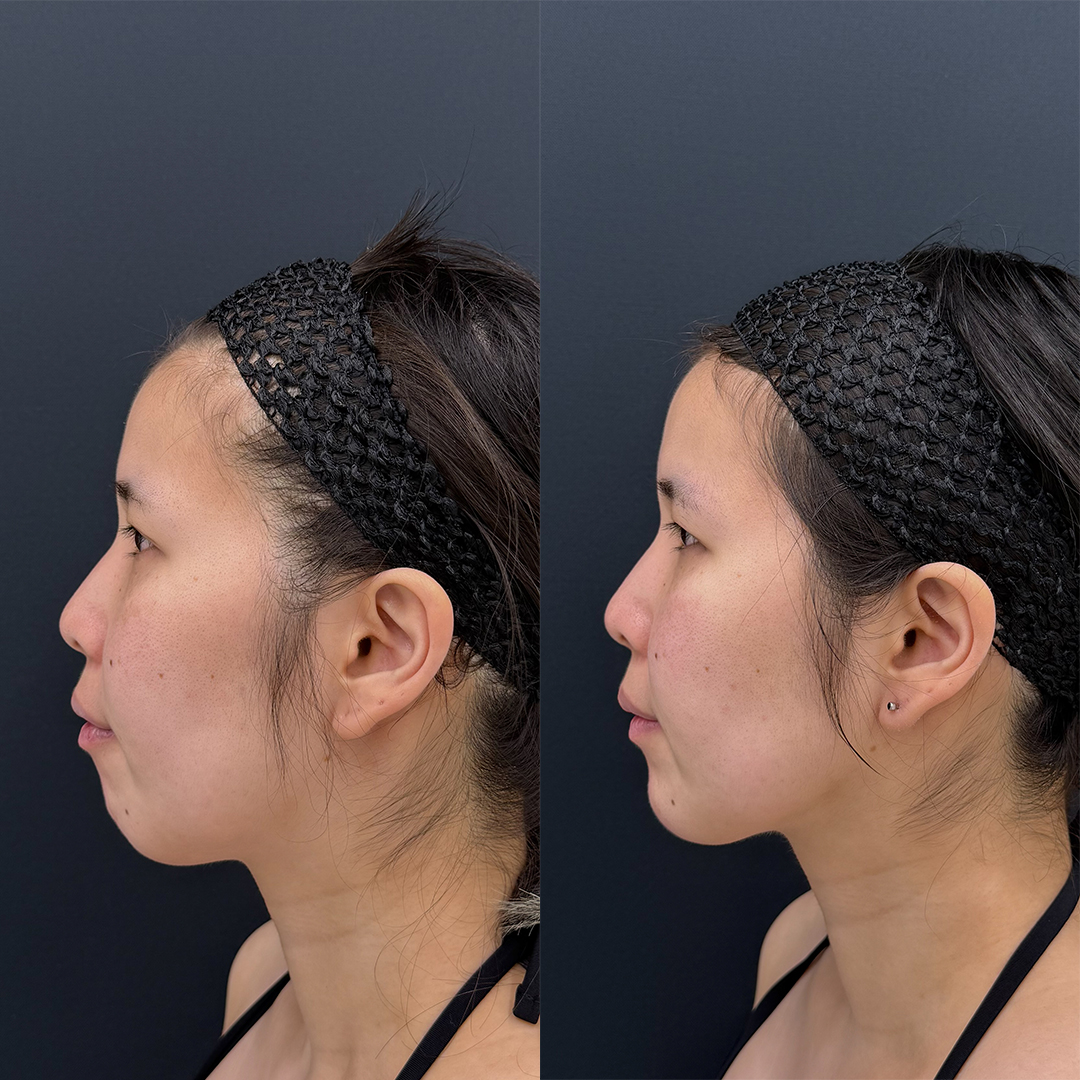 https://purelys-tokyo-clinic.com/wp/wp-content/uploads/2026/02/face-Liposuction_Case-No.397.jpg