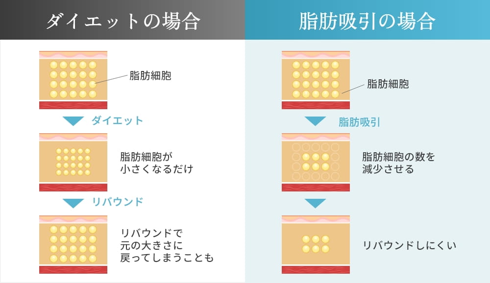 ダイエットの場合と脂肪吸引の場合の太ももの脂肪細胞の数